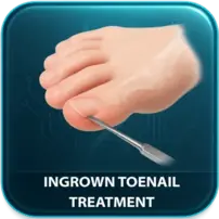 Ingrown Toenail Treatment