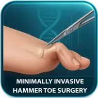 Hammertoe Surgery